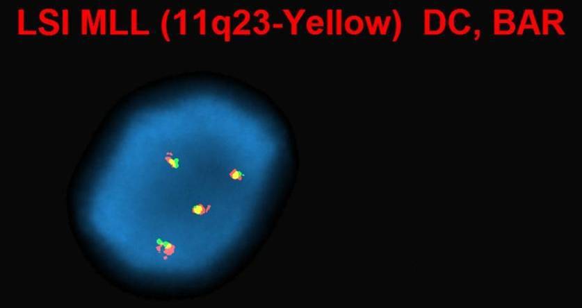 Dual color breakapart probes for 11q23 showing polysomy (+11q)